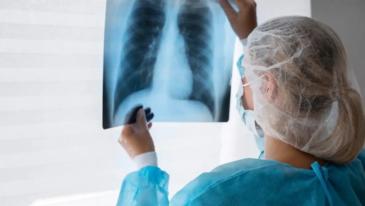 Desarrollos en la terapia de radiación para el cáncer de pulmón